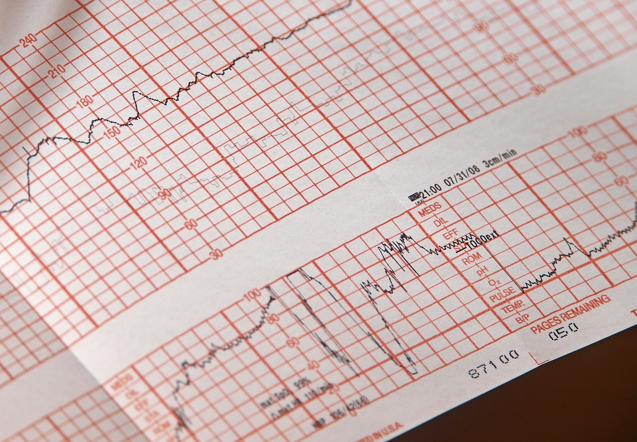 EKG P2P Review for Angina Case